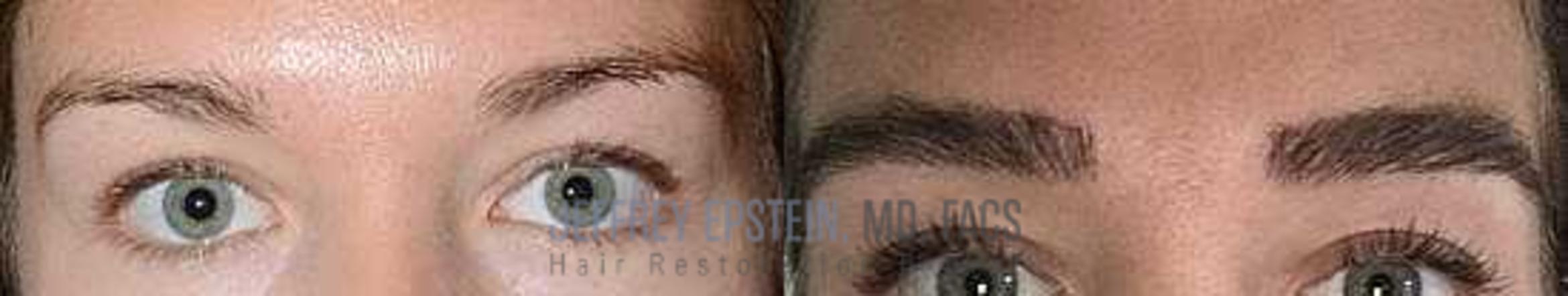 Before & After Eyebrow Transplant Case 170 View 1 in Miami, FL
