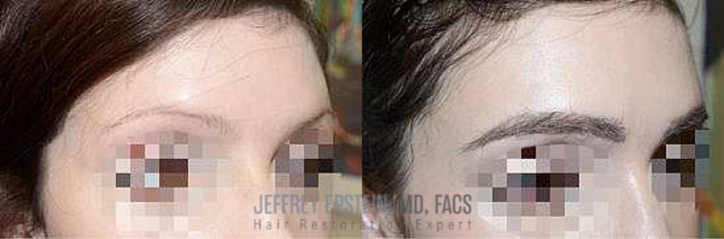 Before & After Eyebrow Transplant Case 195 View 1 in Miami, FL