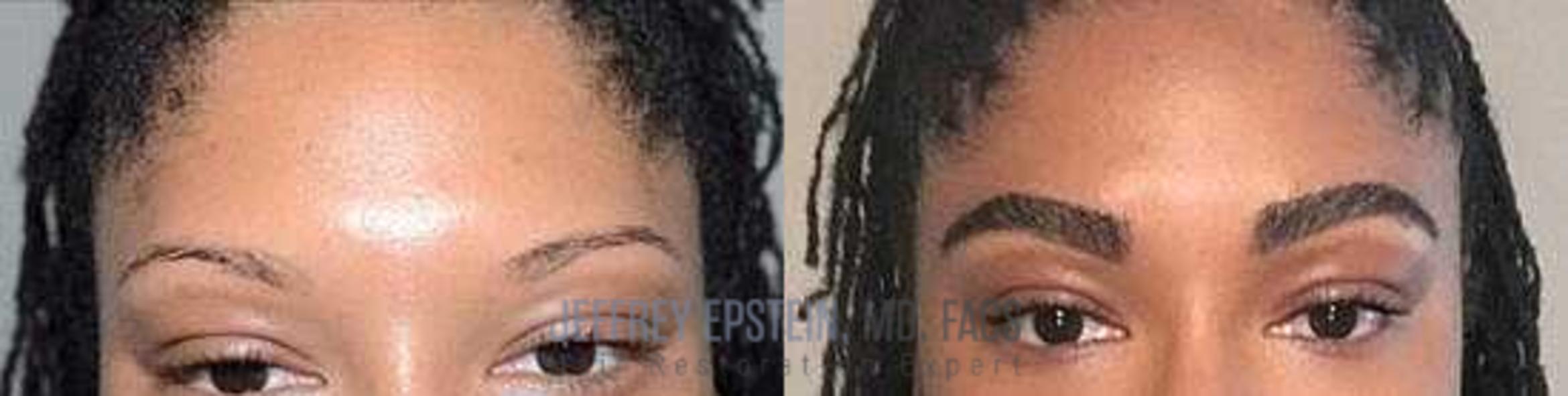 Before & After Eyebrow Transplant Case 300 View 1 in Miami, FL