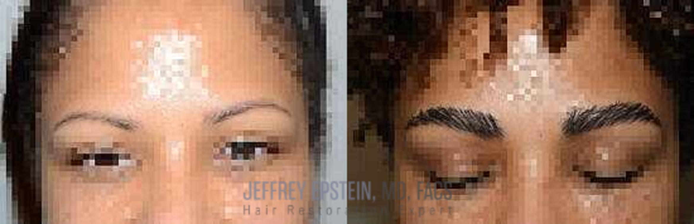 Before & After Eyebrow Transplant Case 303 View 1 in Miami, FL