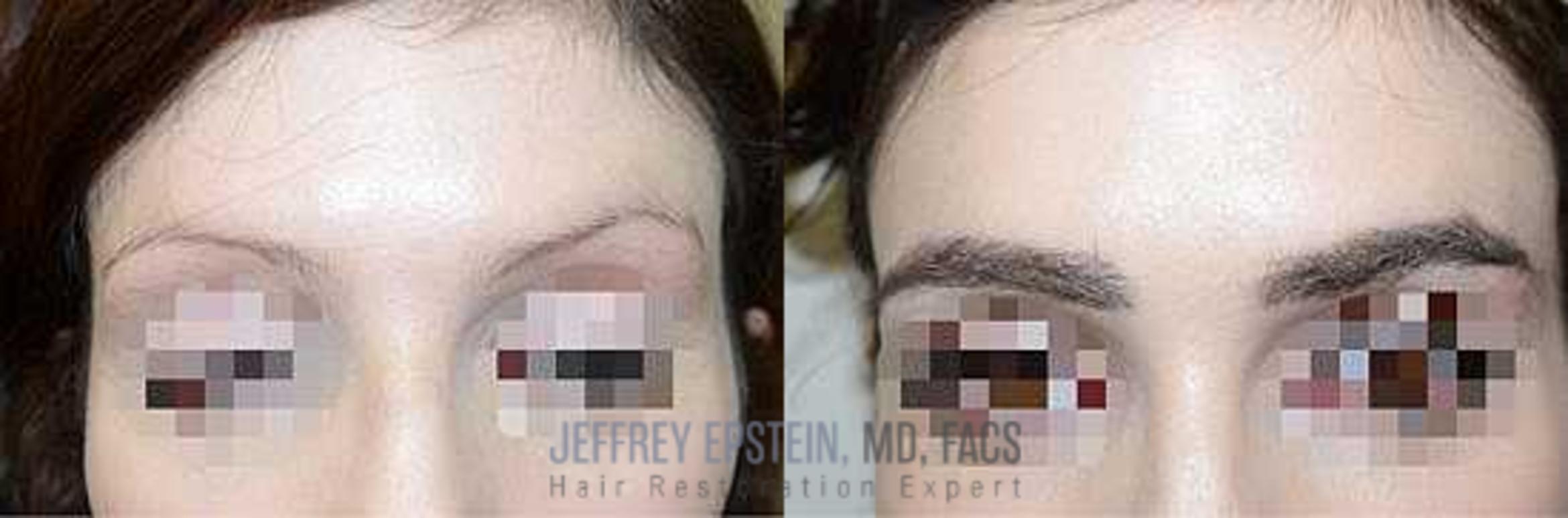 Before & After Eyebrow Transplant Case 318 View 1 in Miami, FL