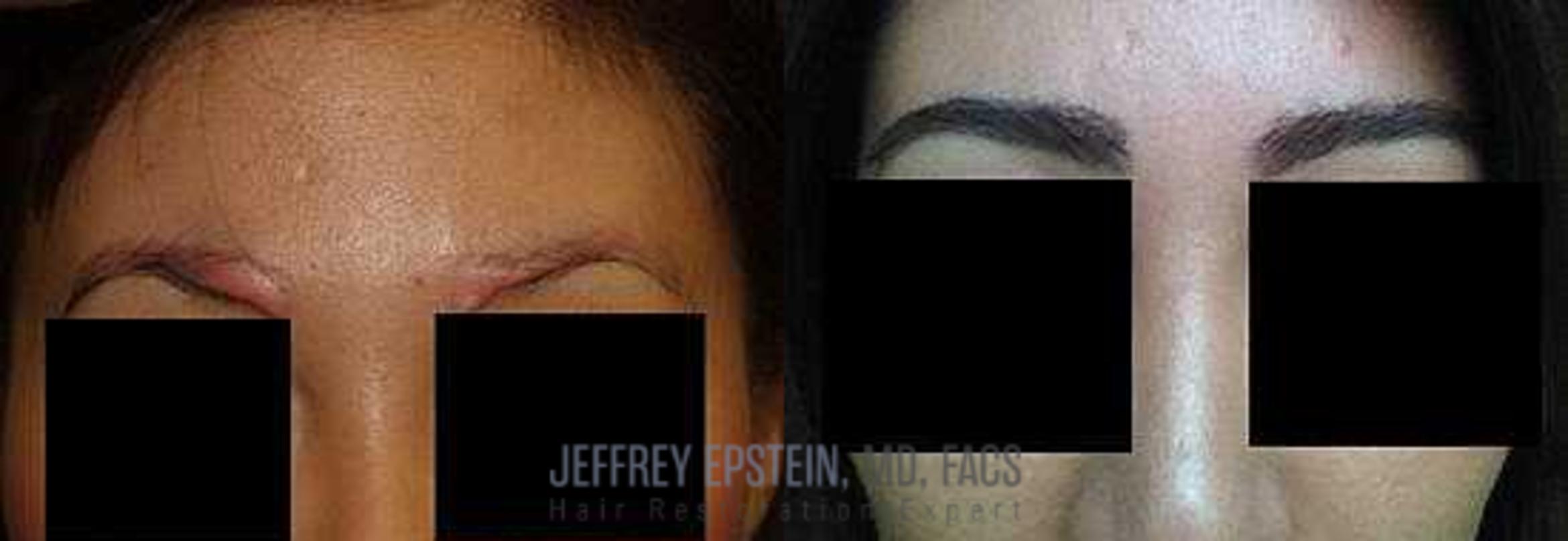 Before & After Eyebrow Transplant Case 338 View 2 in Miami, FL