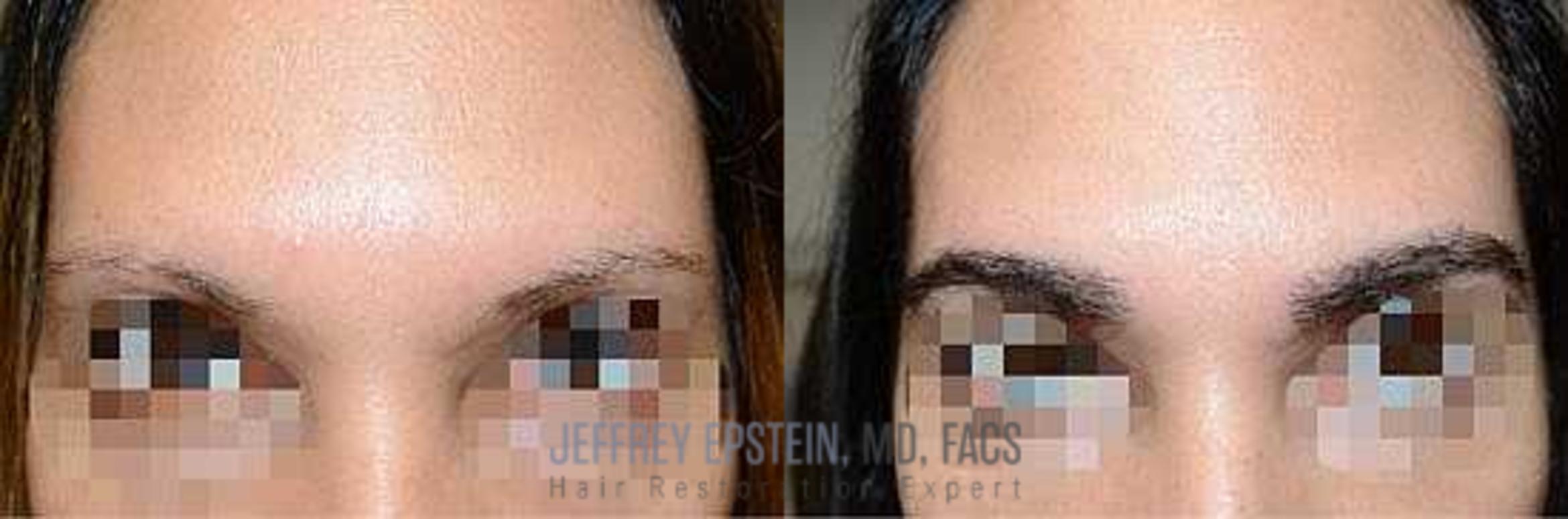 Before & After Eyebrow Transplant Case 339 View 1 in Miami, FL