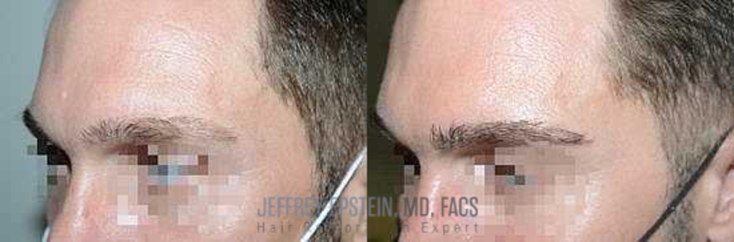 Before & After Eyebrow Transplant Case 342 View 1 in Miami, FL