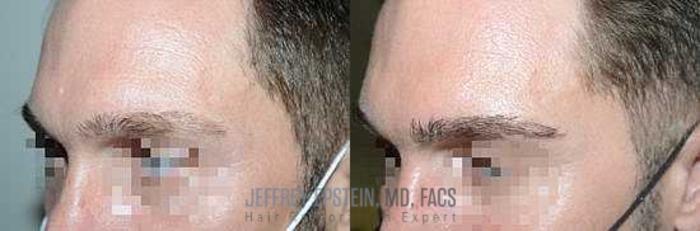 Before & After Eyebrow Transplant Case 342 View 1 View in Miami, FL