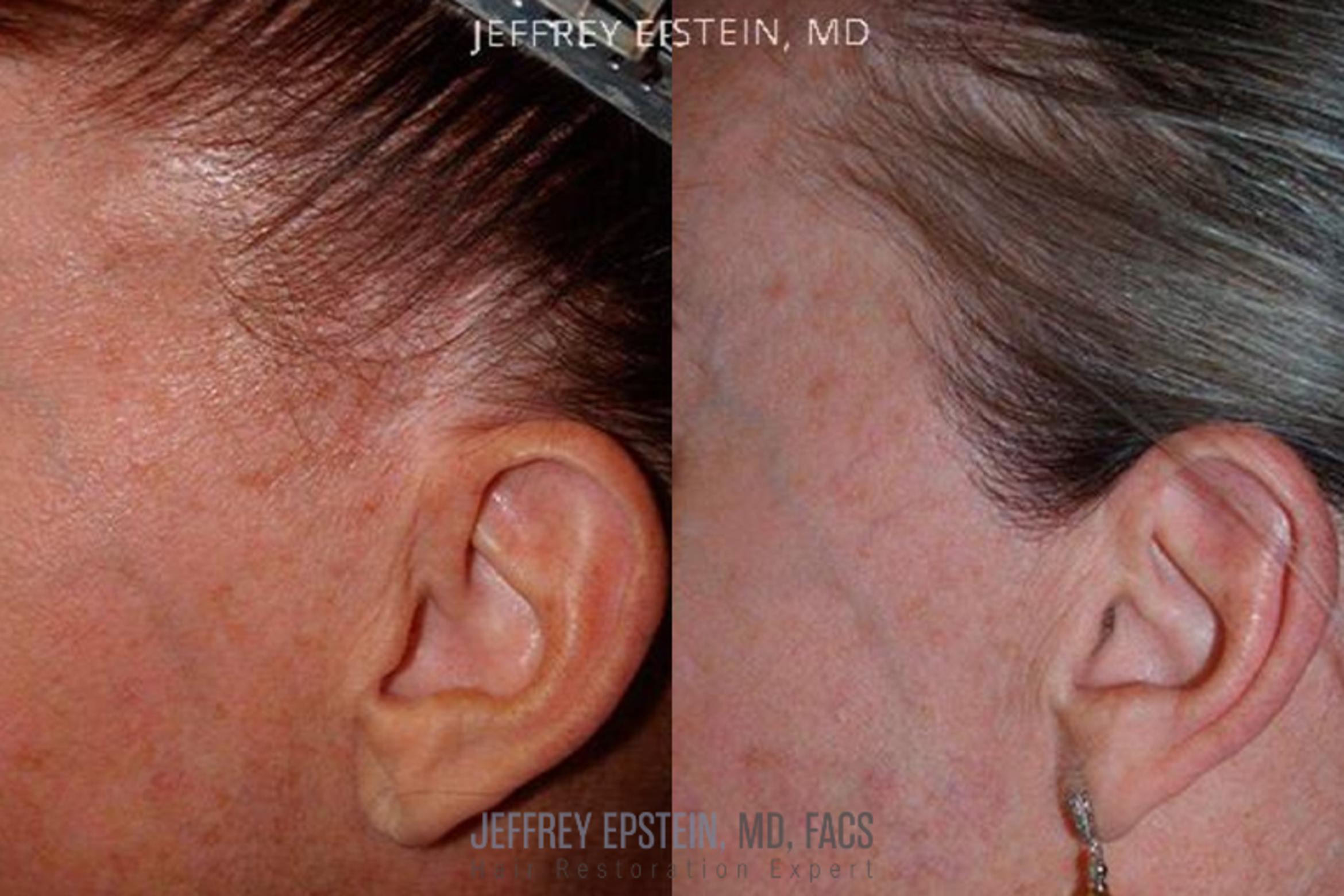 Before & After Facelift & Scar Repair Case 419 Left Side View in Miami, FL