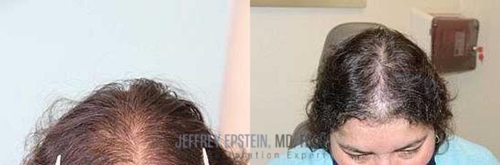 Before & After Hair Loss Medication Case 415 View 1 View in Miami, FL
