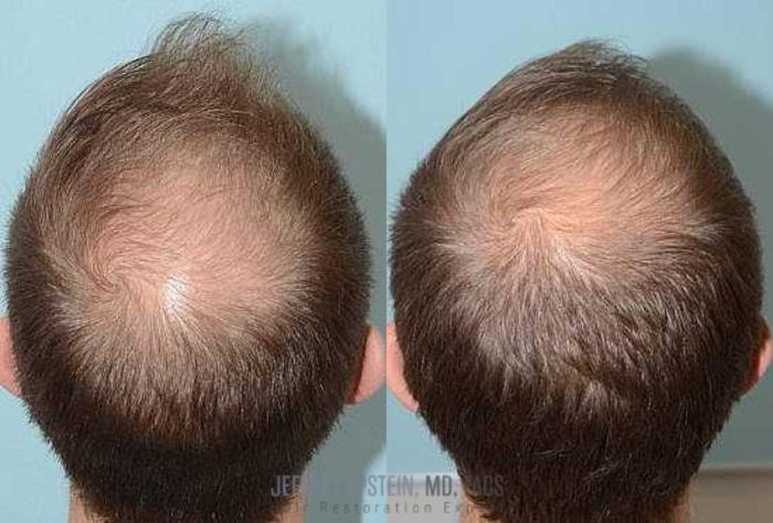 Before & After Hair Loss Medication Case 416 View 1 View in Miami, FL