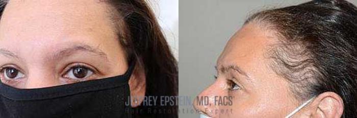 Before & After Hair Loss Medication Case 417 View 1 View in Miami, FL