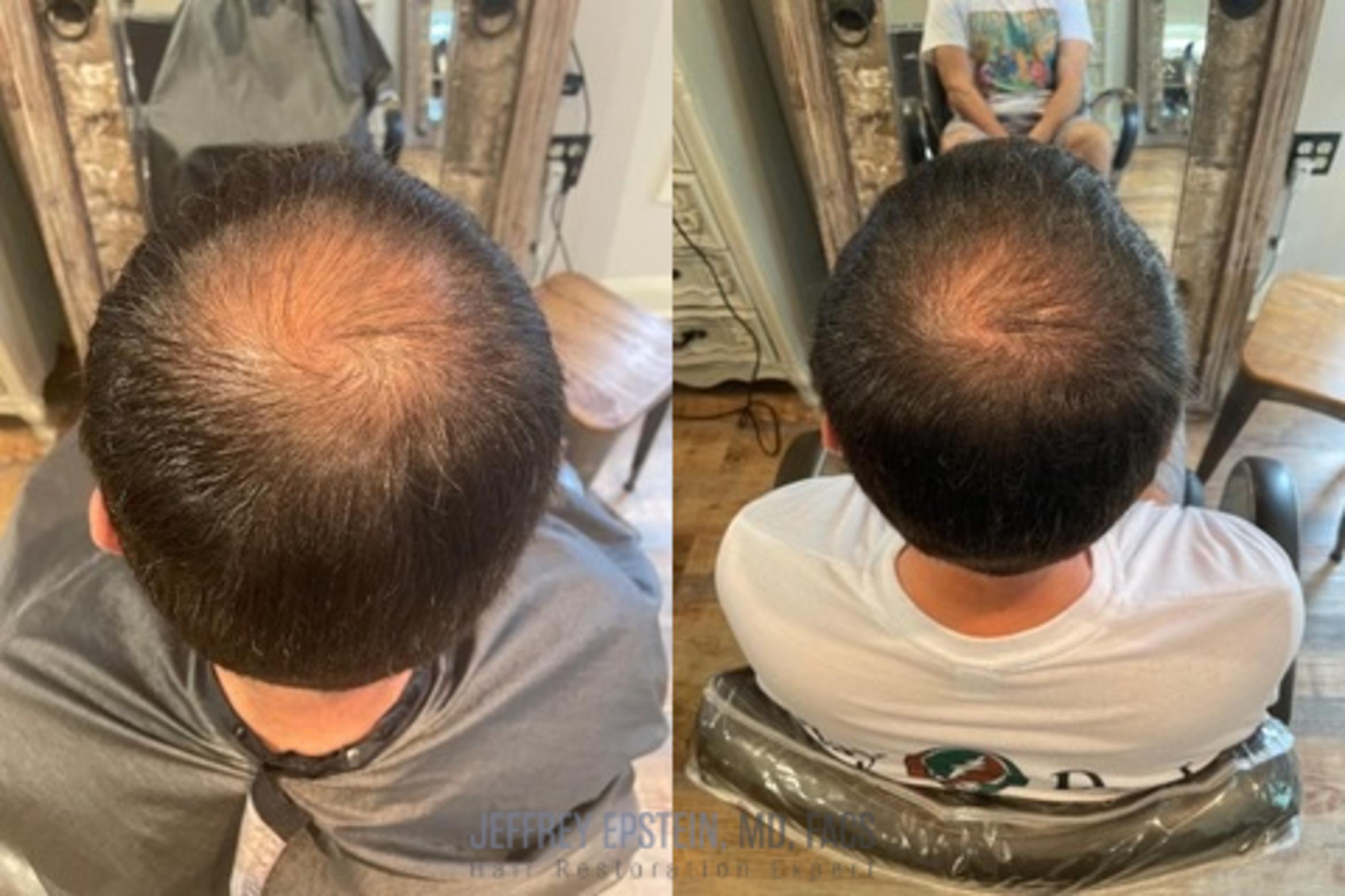 Before & After Hair Red Light Therapy Case 414 View 1 in Miami, FL