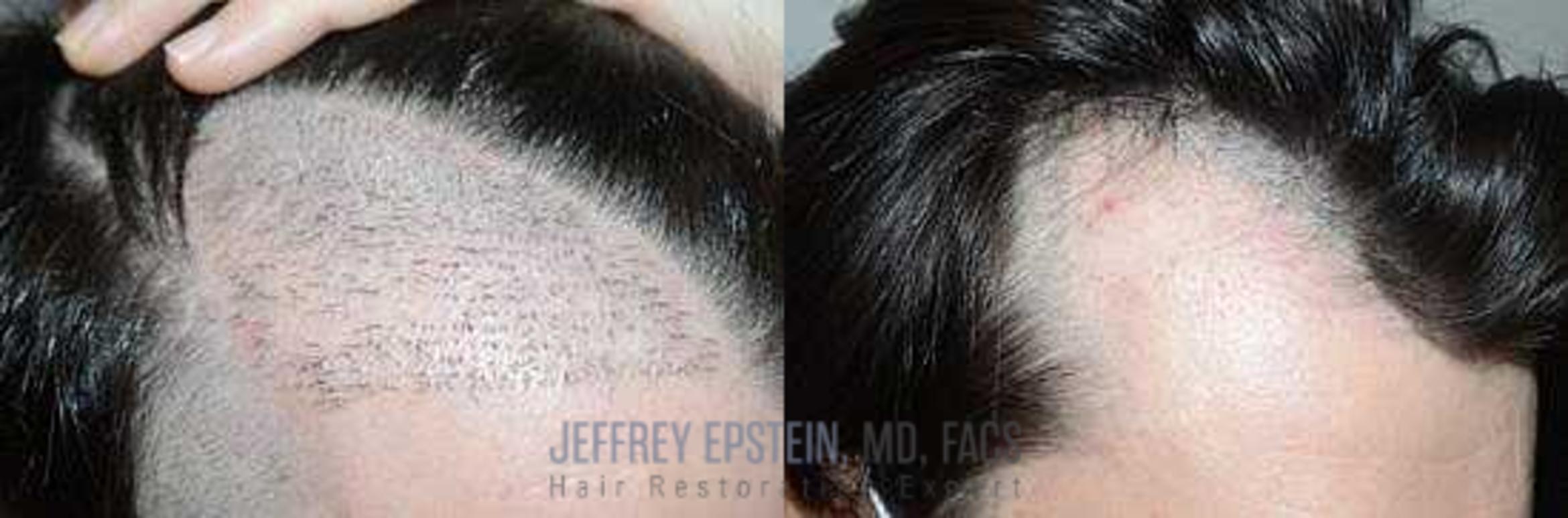 Before & After Hair Transplant Repair Case 101 View 1 in Miami, FL