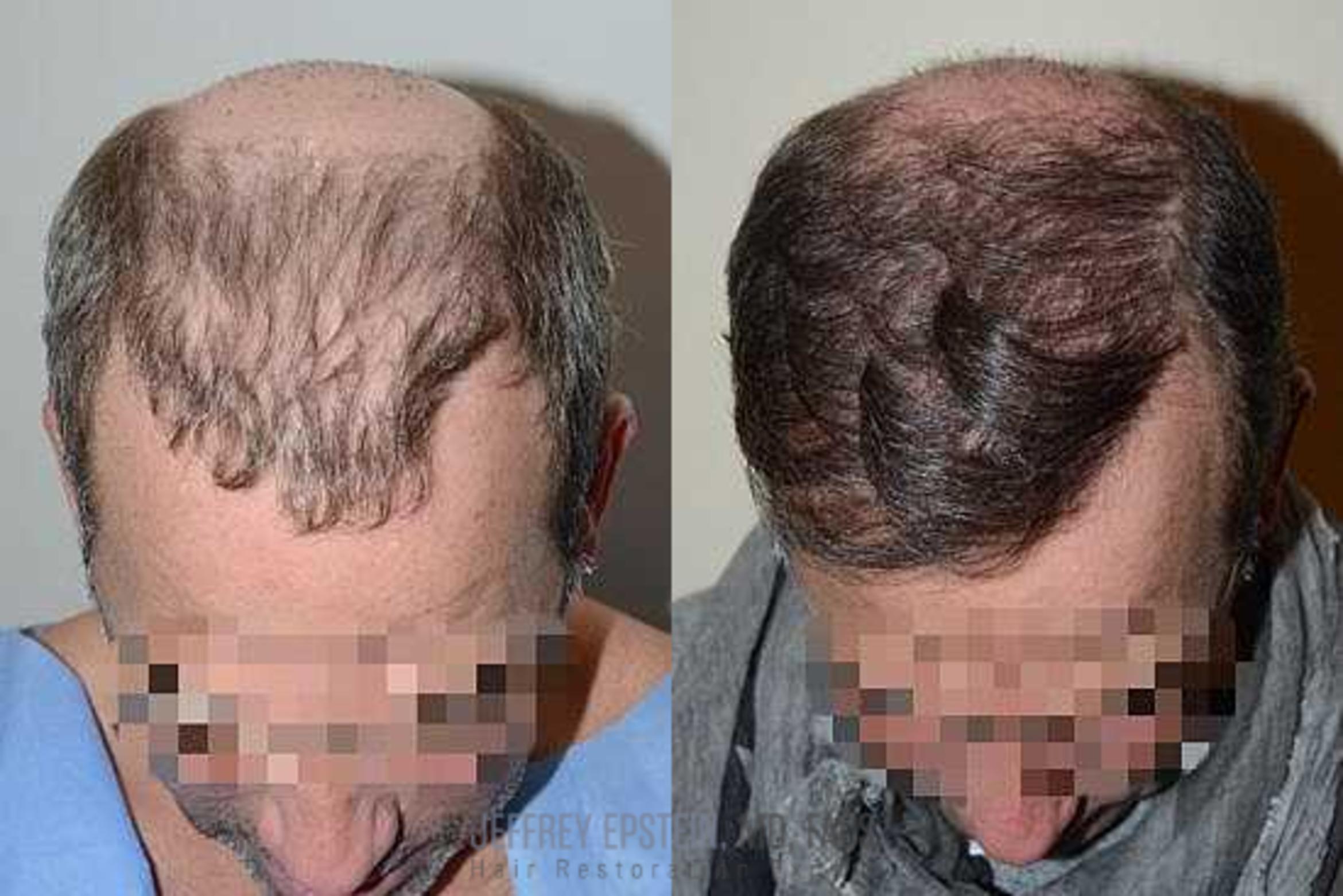 Before & After Hair Transplant Repair Case 112 View 1 in Miami, FL
