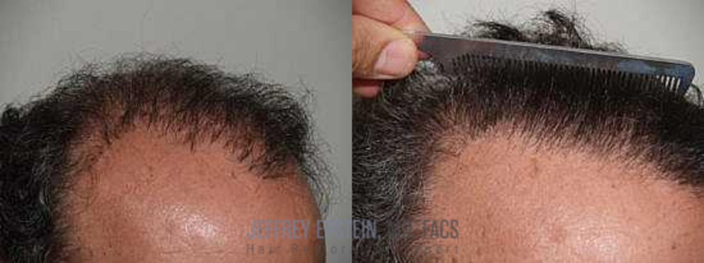 Before & After Hair Transplant Repair Case 137 View 1 in Miami, FL