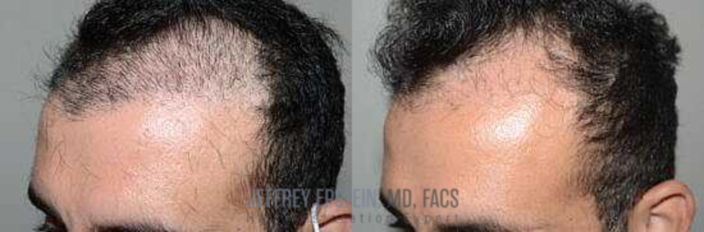 Before & After Hair Transplant Repair Case 14 View 1 in Miami, FL