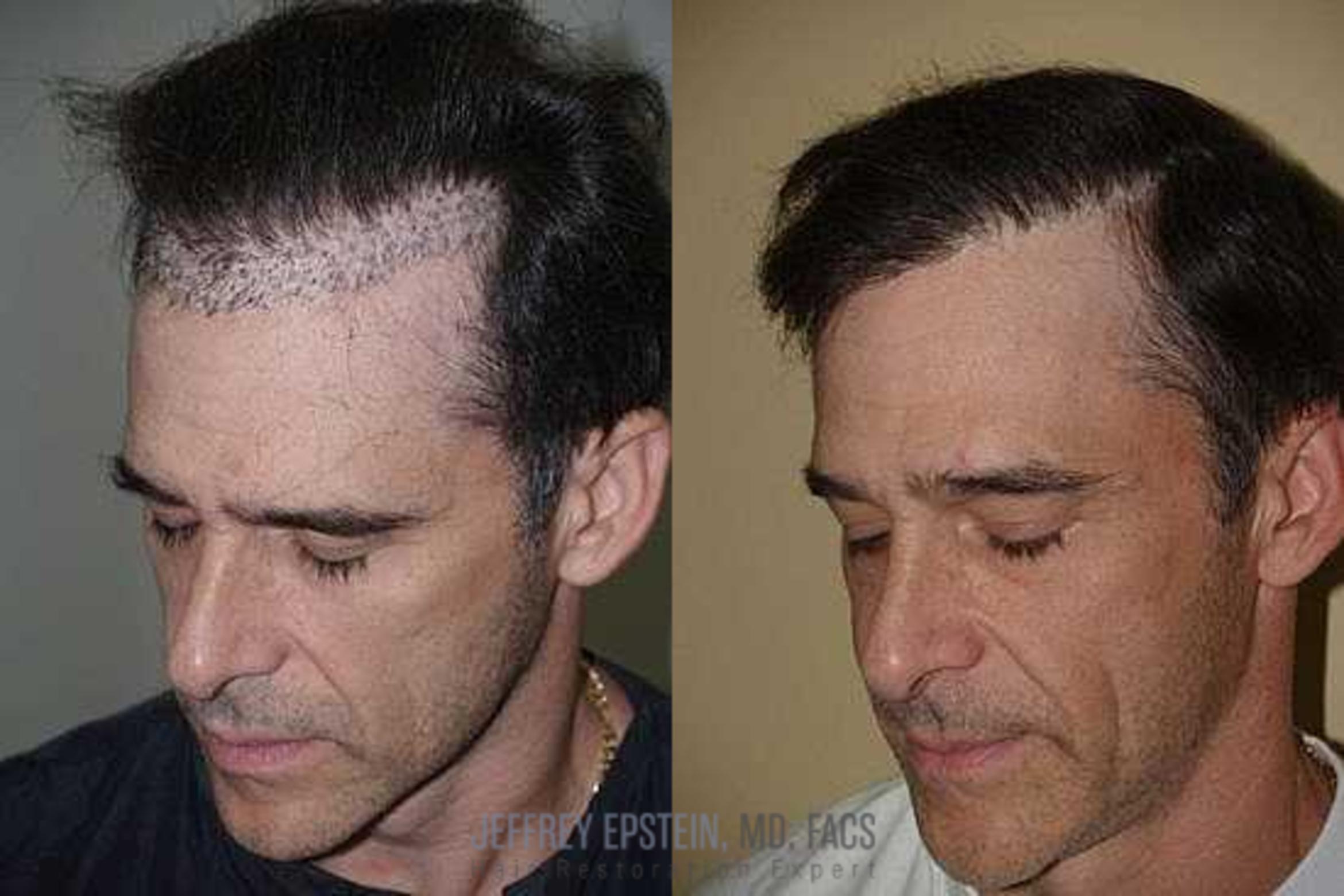 Before & After Hair Transplant Repair Case 148 View 1 in Miami, FL
