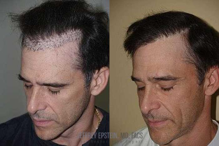 Before & After Hair Transplant Repair Case 148 View 1 View in Miami, FL