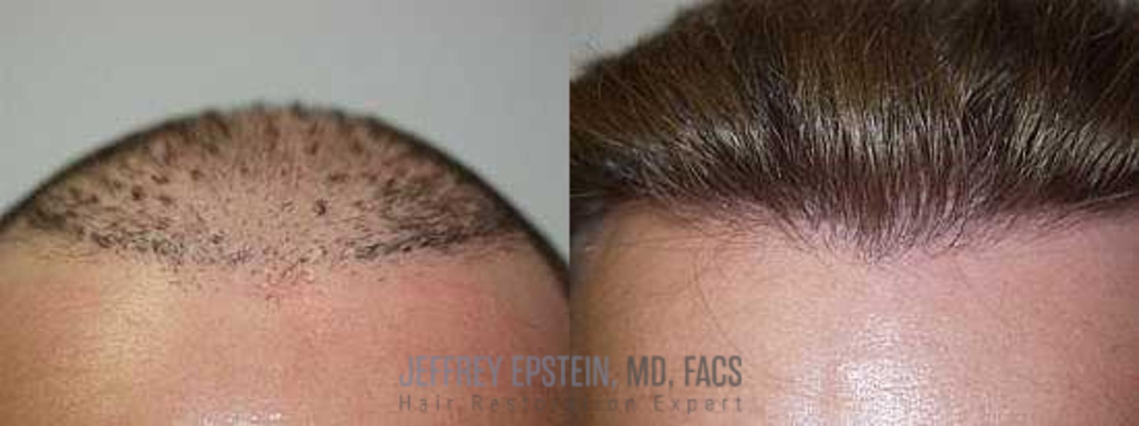 Before & After Hair Transplant Repair Case 150 View 1 in Miami, FL