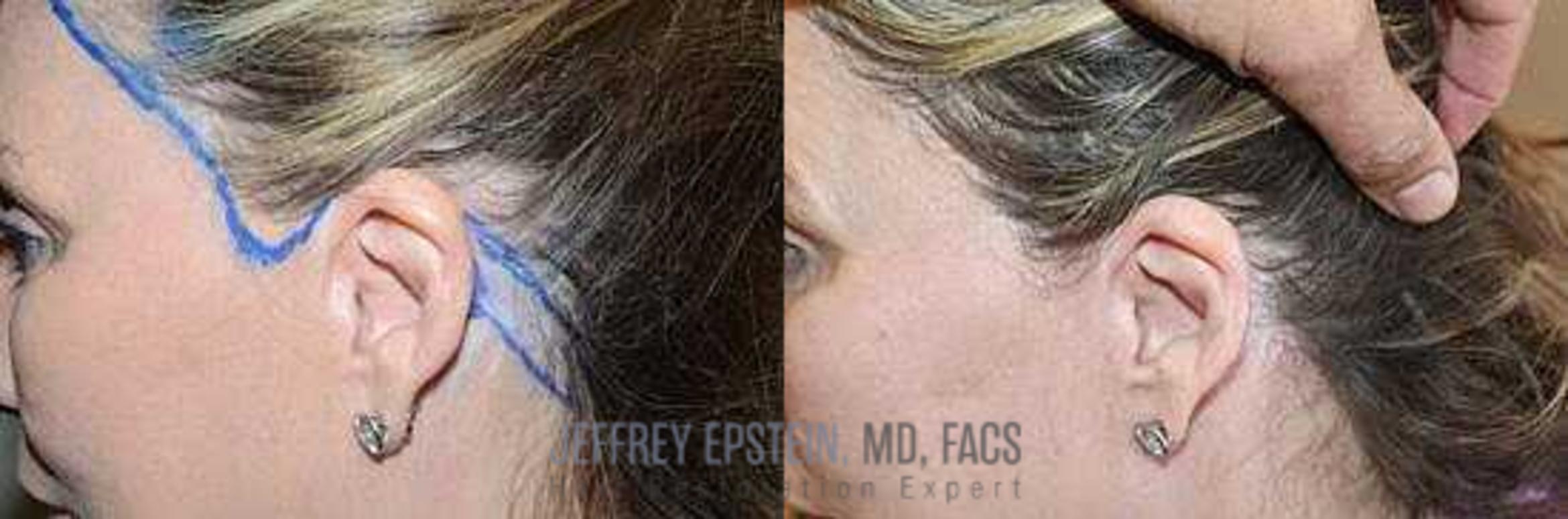 Before & After Hair Transplant Repair Case 161 View 1 in Miami, FL