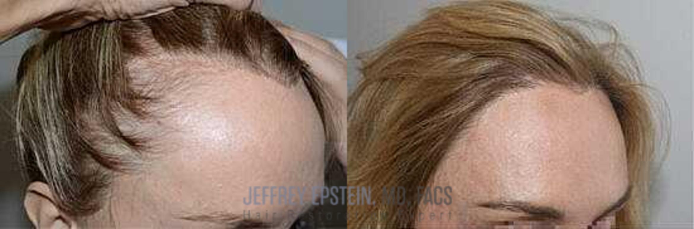Before & After Hair Transplant Repair Case 167 View 1 in Miami, FL
