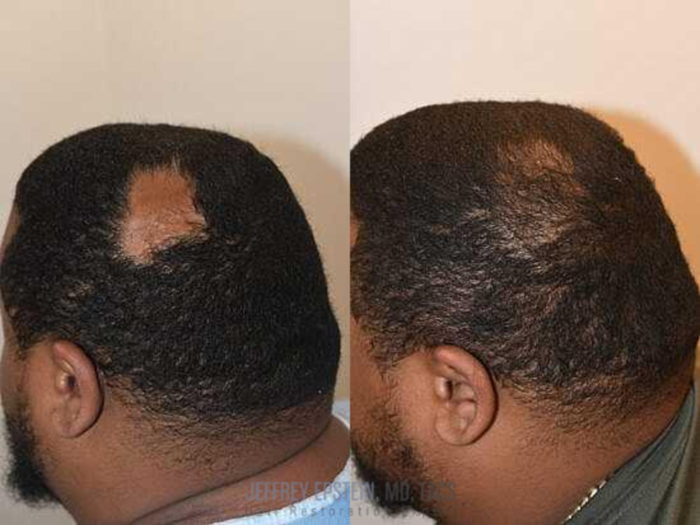 Before & After Hair Transplant Repair Case 44 View 1 in Miami, FL