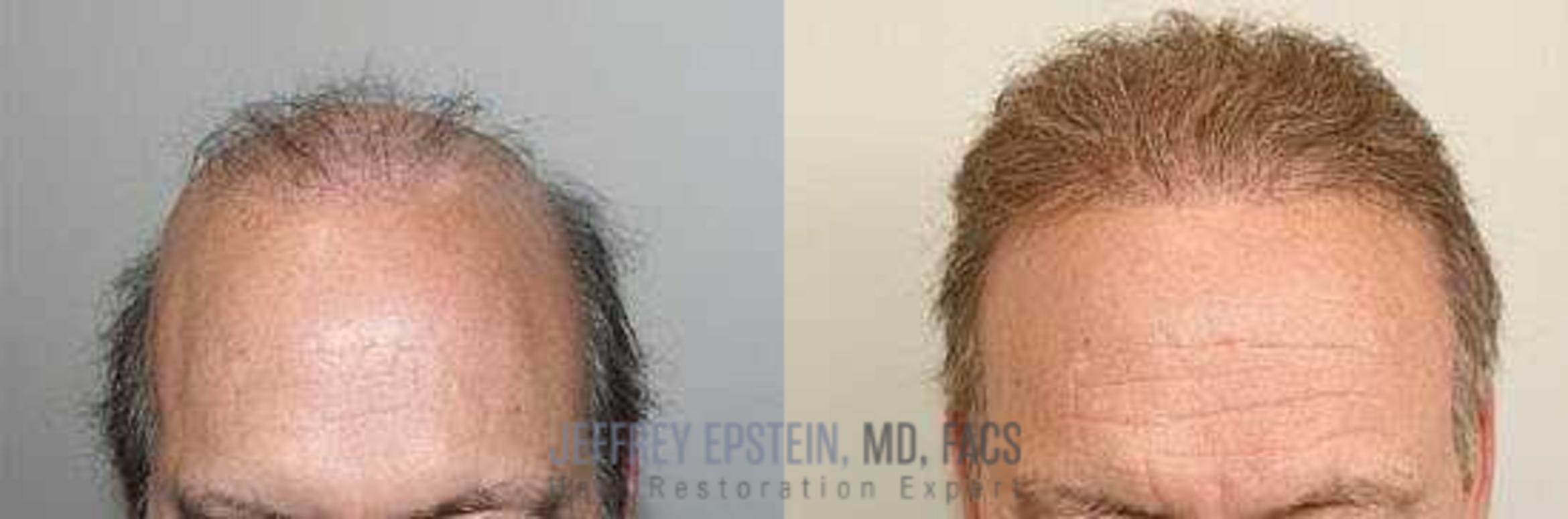 Before & After Hair Transplant Repair Case 5 View 1 in Miami, FL