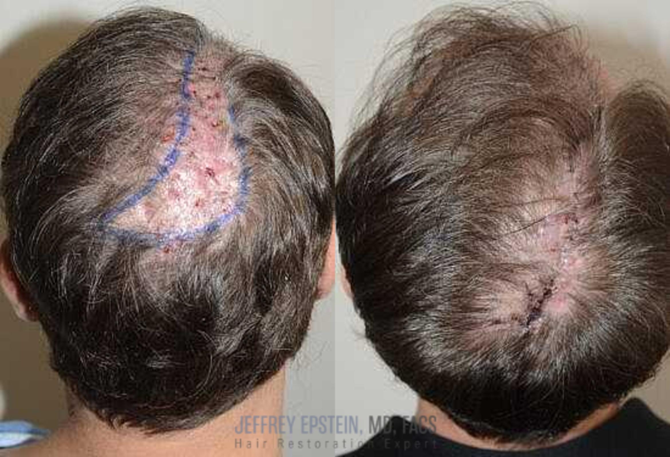 Before & After Hair Transplant Repair Case 87 View 1 in Miami, FL
