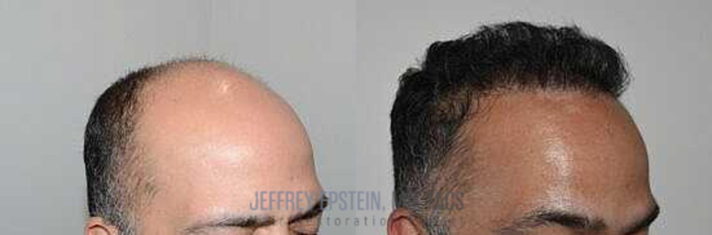 Before & After Hair Transplants For Men Case 1 View 1 in Miami, FL