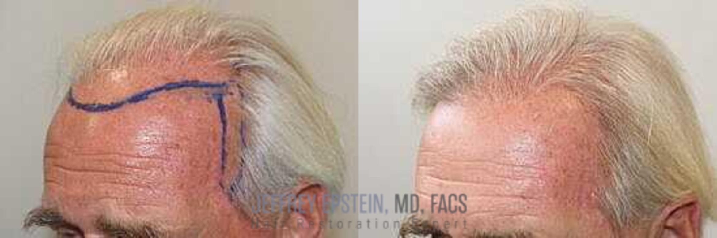 Before & After Hair Transplants For Men Case 11 View 1 in Miami, FL