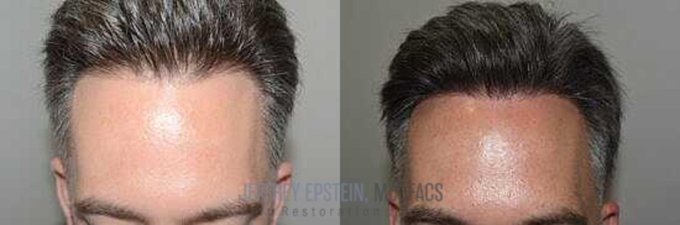 Before & After Hair Transplants For Men Case 19 View 1 in Miami, FL