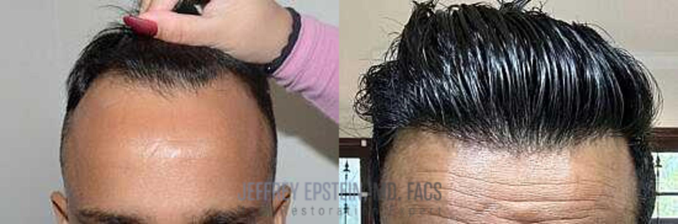 Before & After Hair Transplants For Men Case 2 View 1 in Miami, FL