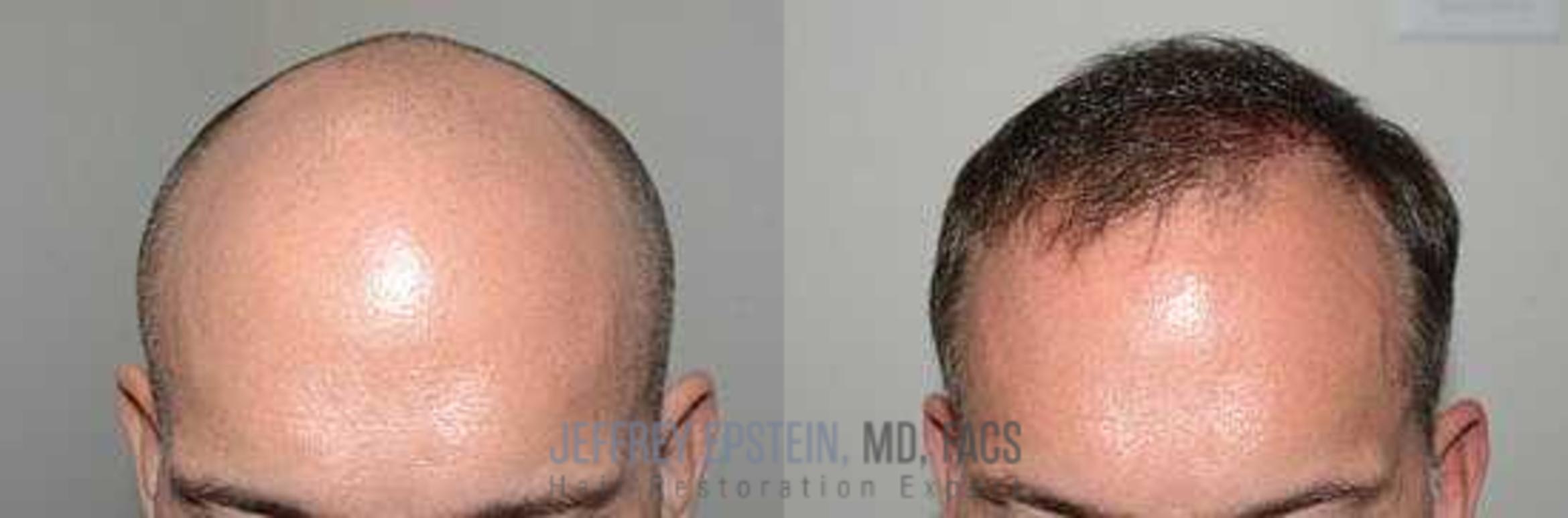 Before & After Hair Transplants For Men Case 28 View 1 in Miami, FL