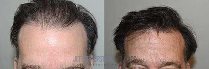 Before & After Hair Transplants For Men Case 348 View 1 View in Miami, FL