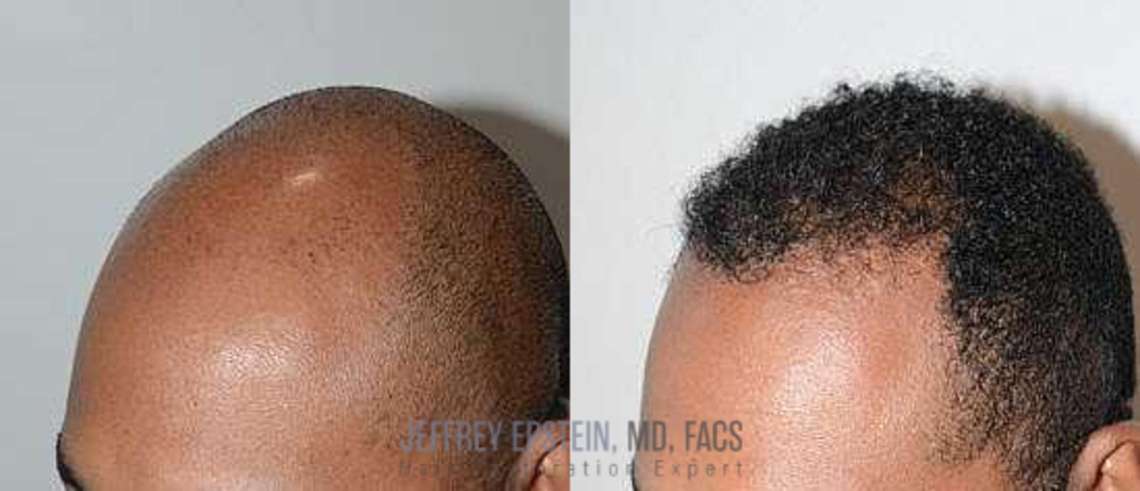 Before & After Hair Transplants For Men Case 49 View 1 in Miami, FL