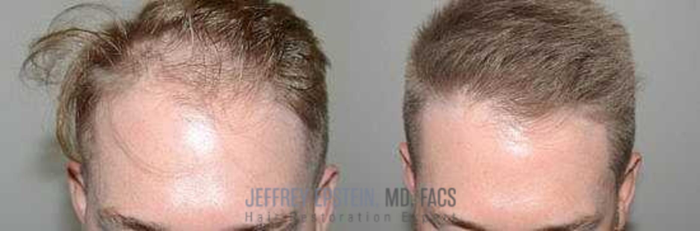 Before & After Hair Transplants For Men Case 6 View 1 in Miami, FL