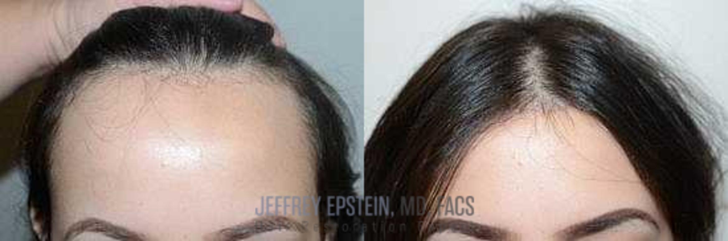 Before & After Hairline Lowering / Forehead Reduction Case 239 View 1 in Miami, FL