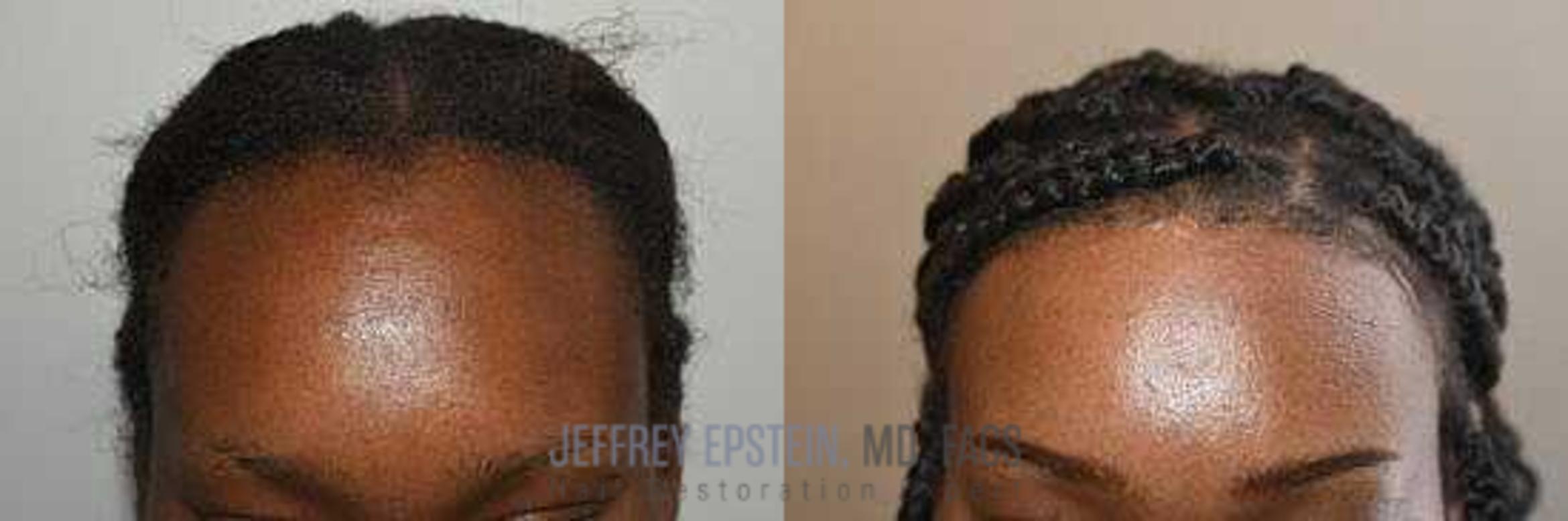 Before & After Hairline Lowering / Forehead Reduction Case 243 View 1 in Miami, FL