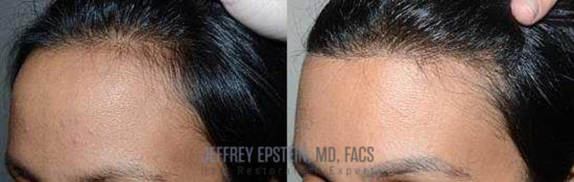 Before & After Hairline Lowering / Forehead Reduction Case 260 View 1 in Miami, FL