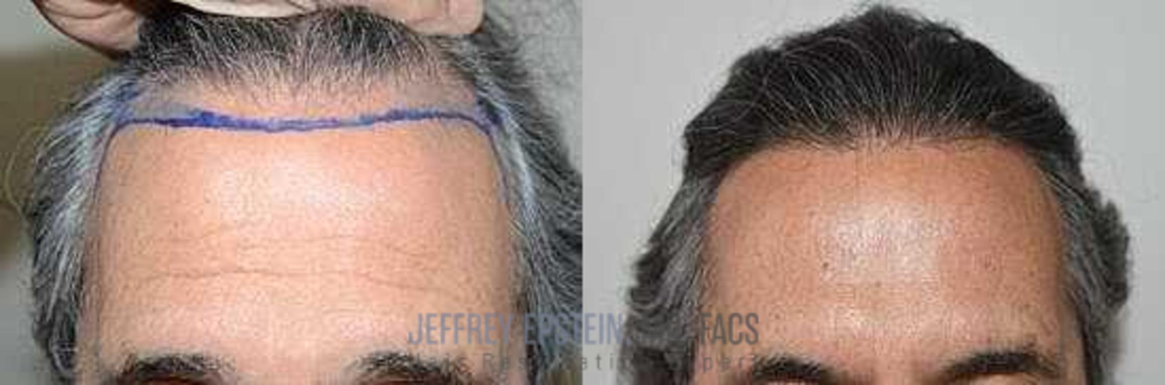 Before & After Hairline Lowering / Forehead Reduction Case 344 View 1 in Miami, FL