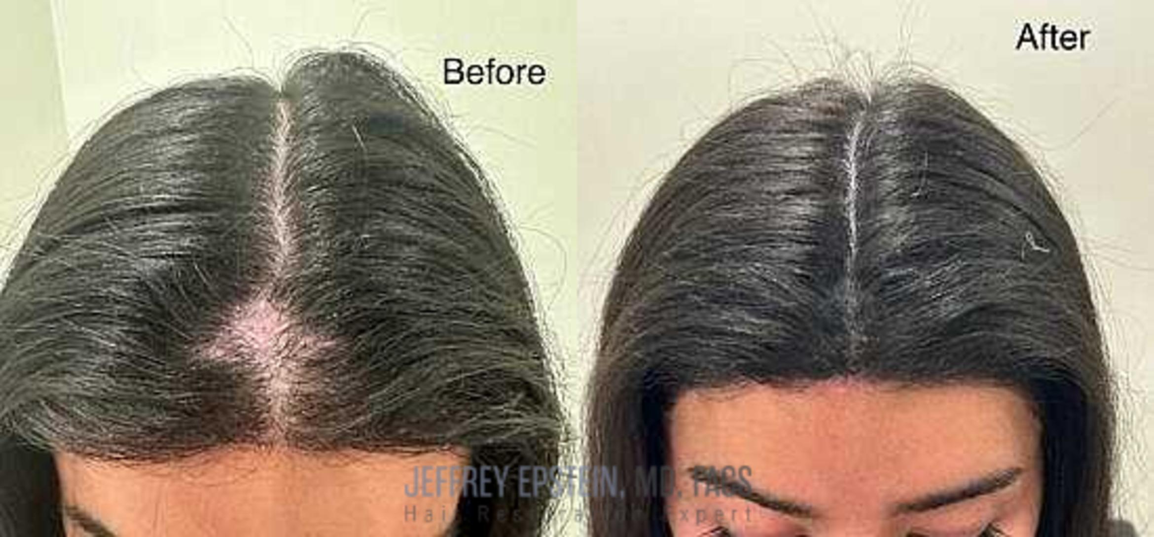 Before & After Scalp Micropigmentation Case 363 View 1 in Miami, FL