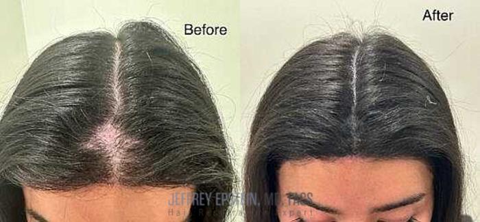 Before & After Scalp Micropigmentation Case 363 View 1 View in Miami, FL