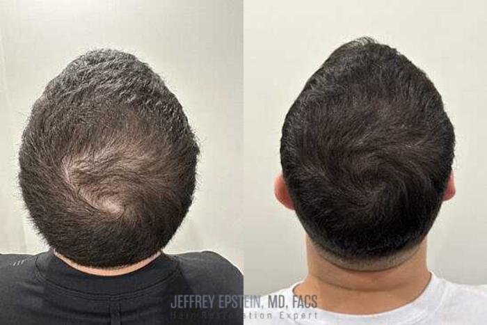 Before & After Scalp Micropigmentation Case 365 View 1 View in Miami, FL