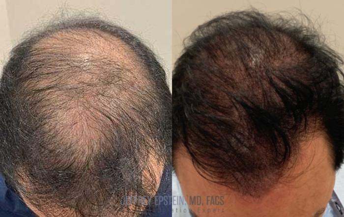 Before & After Scalp Micropigmentation Case 368 View 1 View in Miami, FL