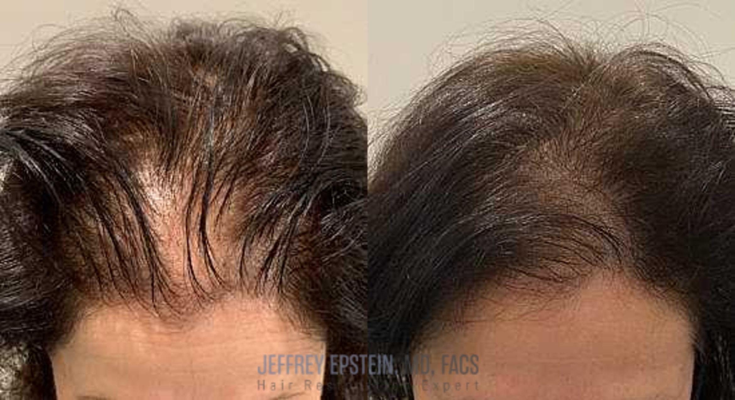 Before & After Scalp Micropigmentation Case 369 View 1 in Miami, FL