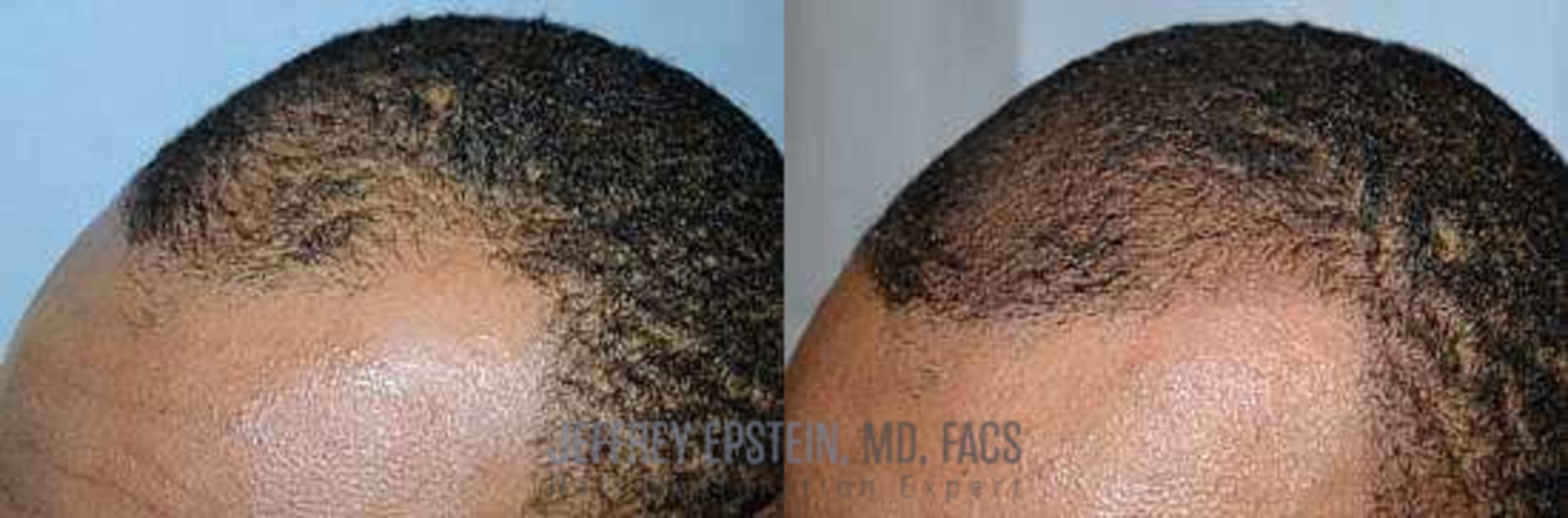 Before & After Scalp Micropigmentation Case 374 View 1 in Miami, FL