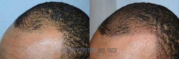 Before & After Scalp Micropigmentation Case 374 View 1 View in Miami, FL