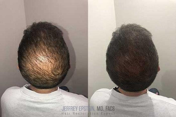 Before & After Scalp Micropigmentation Case 375 View 1 View in Miami, FL