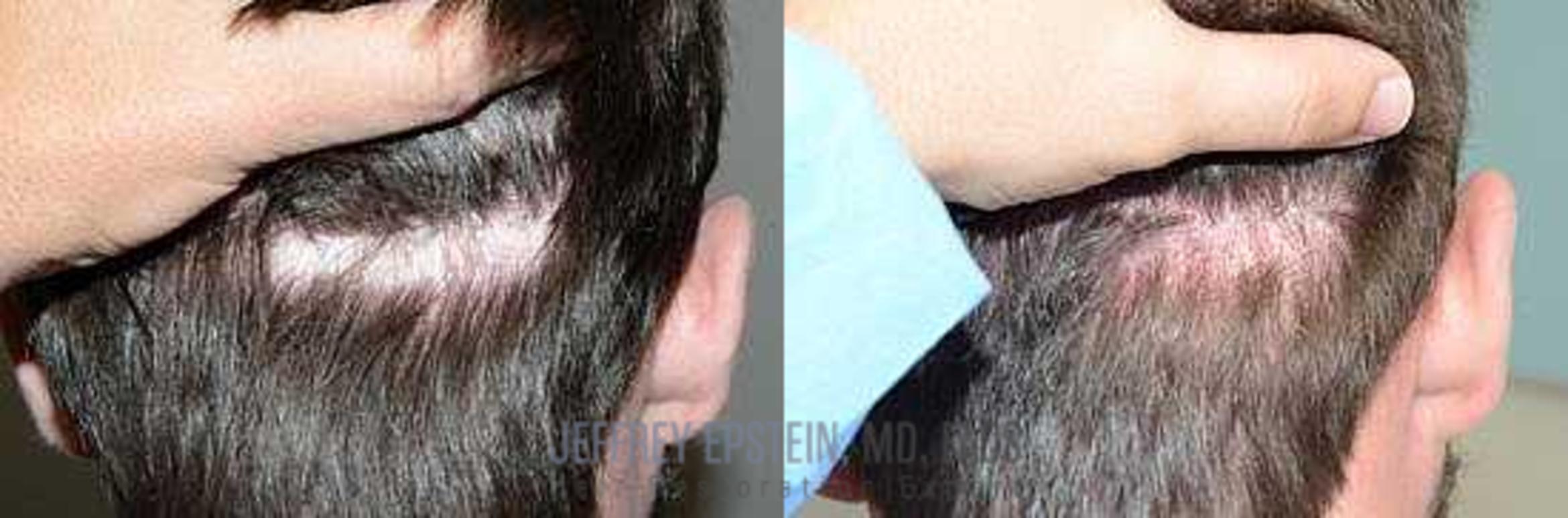 Before & After Scalp Micropigmentation Case 378 View 1 in Miami, FL