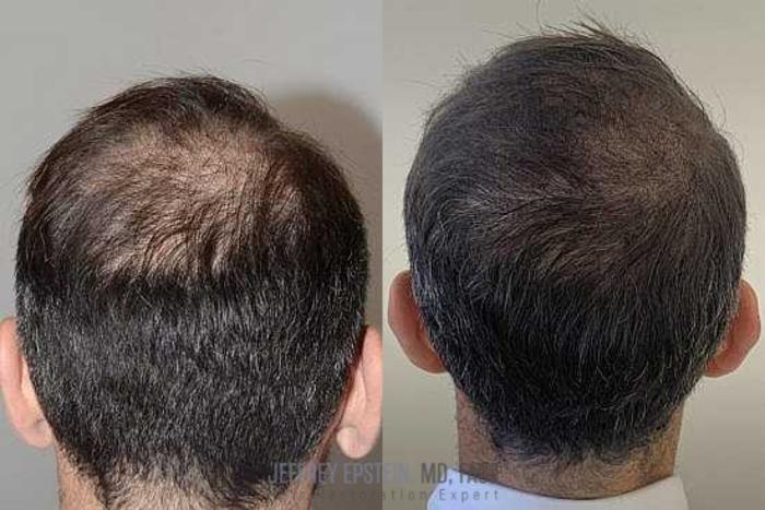 Before & After Scalp Micropigmentation Case 379 View 1 View in Miami, FL
