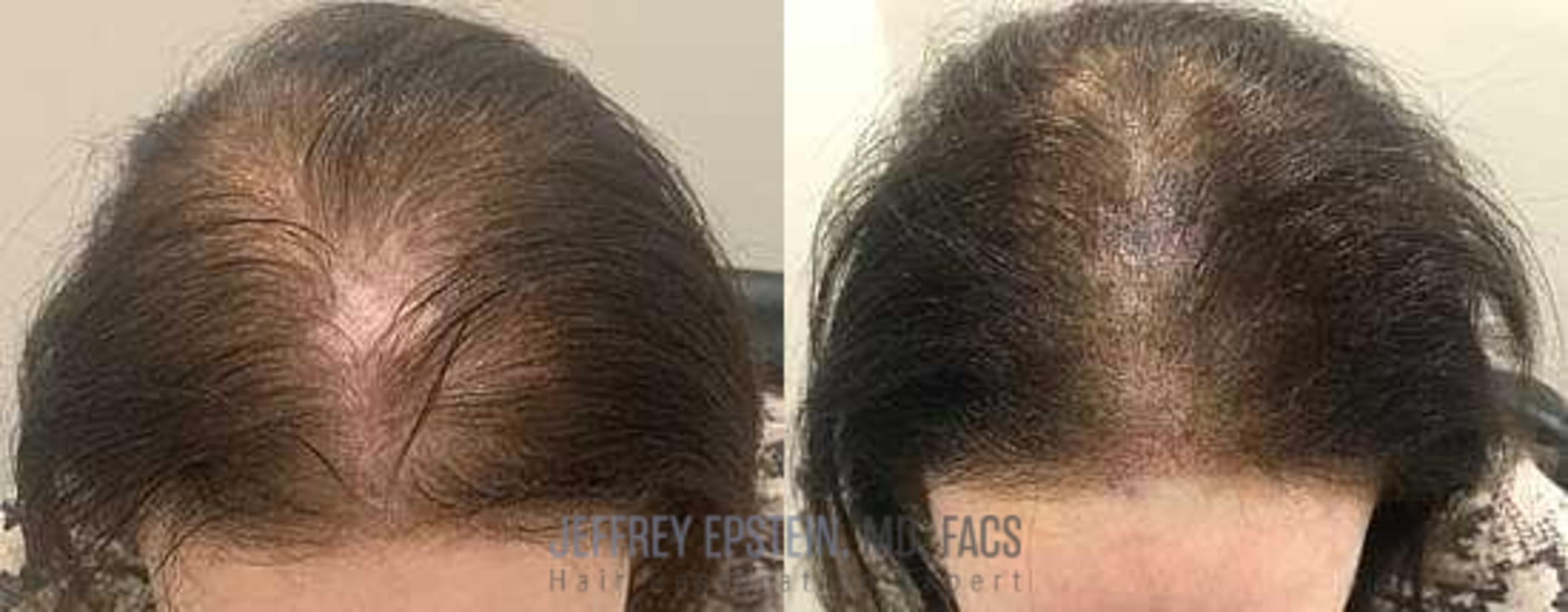 Before & After Scalp Micropigmentation Case 382 View 1 in Miami, FL