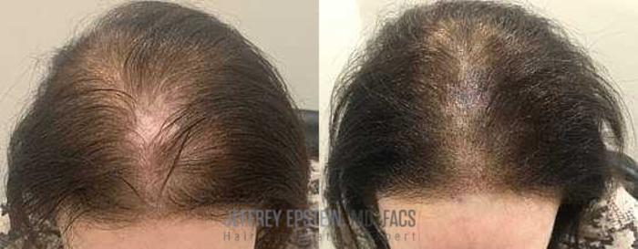 Before & After Scalp Micropigmentation Case 382 View 1 View in Miami, FL